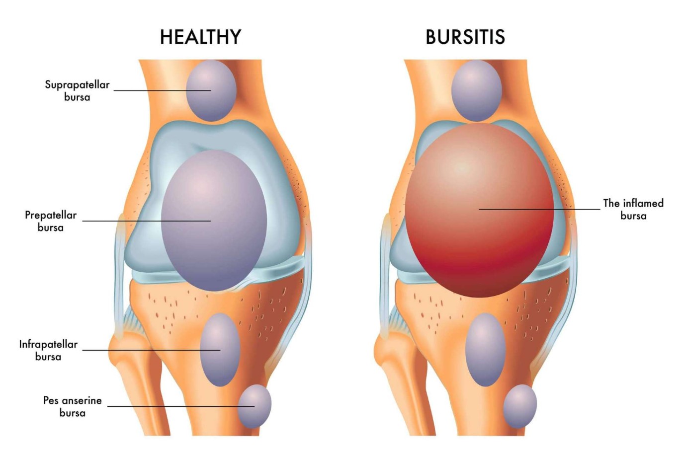 What Does A Bursa Look Like